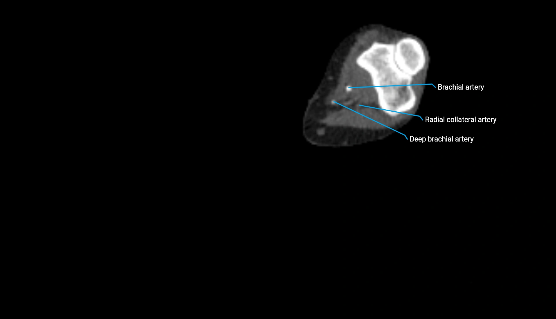 CTA upper limb axial cross sectional anatomy labelled image 188 (2).webp